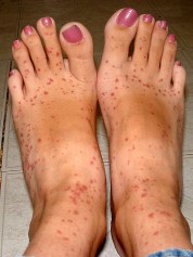 Clindamycin_rash Clindamycin rash